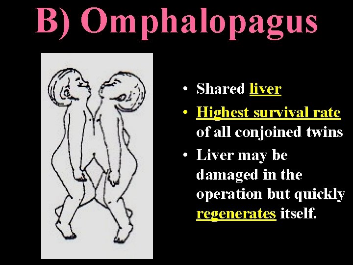 B) Omphalopagus • Shared liver • Highest survival rate of all conjoined twins • B) Omphalopagus • Shared liver • Highest survival rate of all conjoined twins •