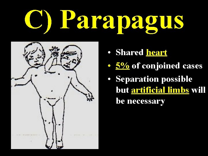 C) Parapagus • Shared heart • 5% of conjoined cases • Separation possible but C) Parapagus • Shared heart • 5% of conjoined cases • Separation possible but