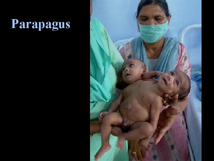 Parapagus Parapagus