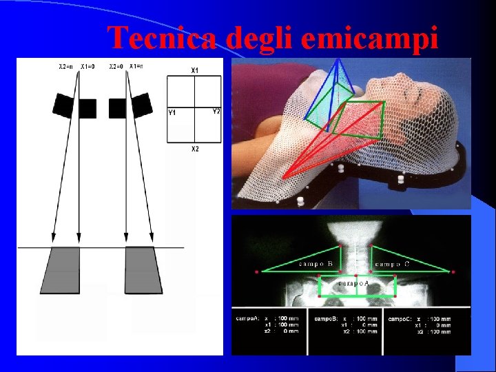 Tecnica degli emicampi 12 