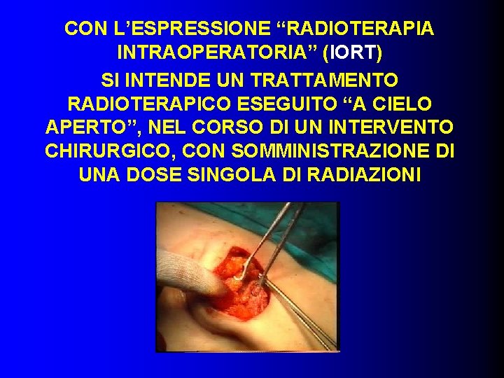 CON L’ESPRESSIONE “RADIOTERAPIA INTRAOPERATORIA” (IORT) SI INTENDE UN TRATTAMENTO RADIOTERAPICO ESEGUITO “A CIELO APERTO”,