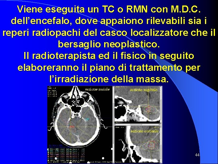 Viene eseguita un TC o RMN con M. D. C. dell’encefalo, dove appaiono rilevabili