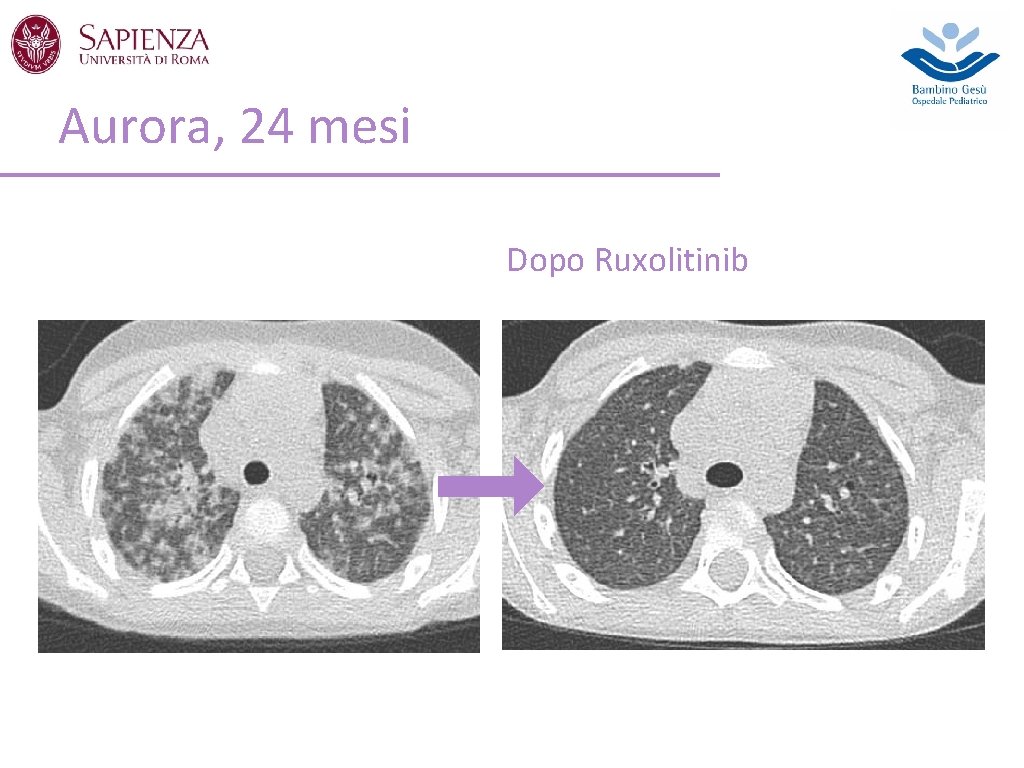 Aurora, 24 mesi Dopo Ruxolitinib 