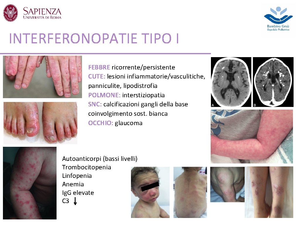 INTERFERONOPATIE TIPO I FEBBRE ricorrente/persistente CUTE: lesioni infiammatorie/vasculitiche, panniculite, lipodistrofia POLMONE: interstiziopatia SNC: calcificazioni