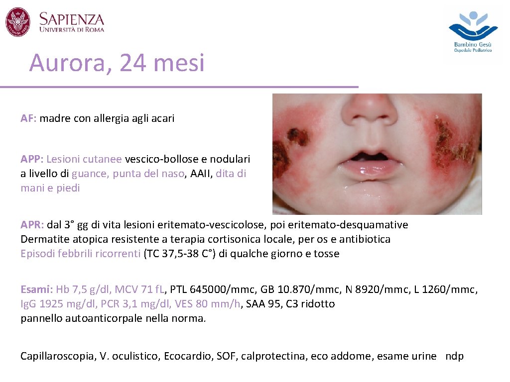 Aurora, 24 mesi AF: madre con allergia agli acari APP: Lesioni cutanee vescico-bollose e