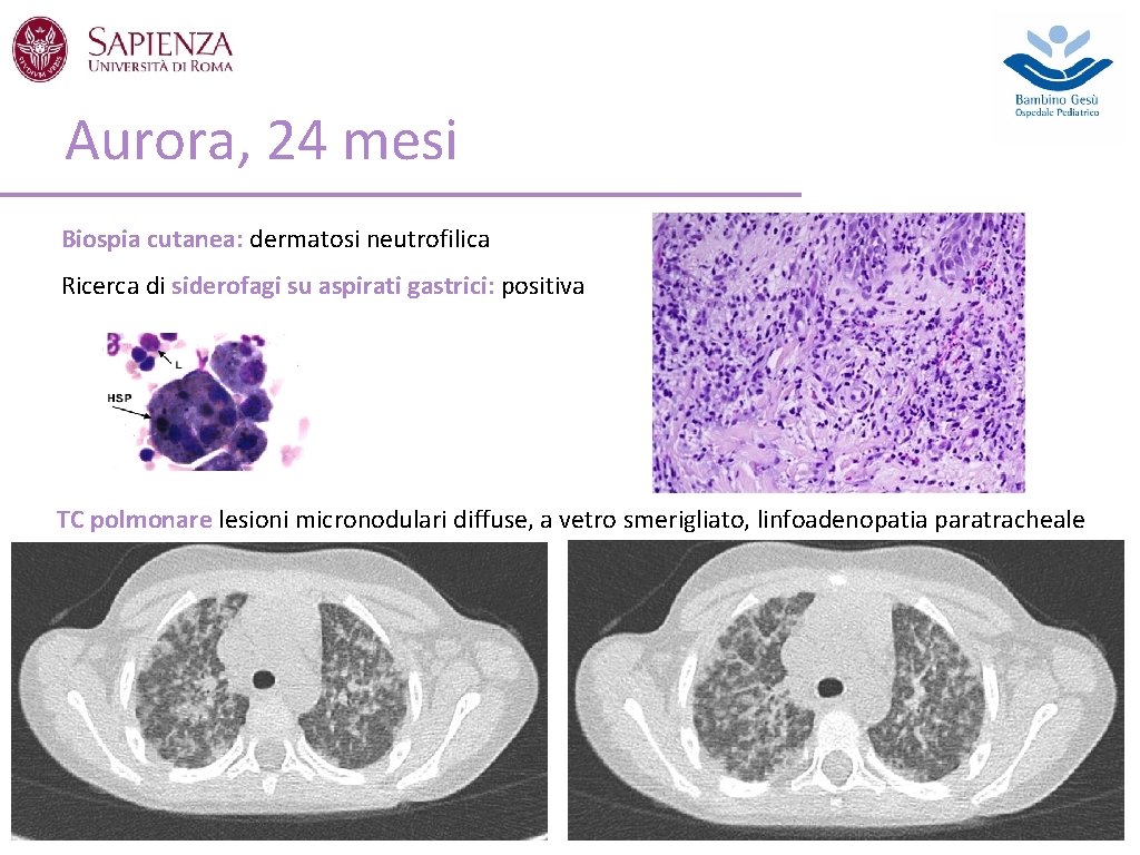 Aurora, 24 mesi Biospia cutanea: dermatosi neutrofilica Ricerca di siderofagi su aspirati gastrici: positiva