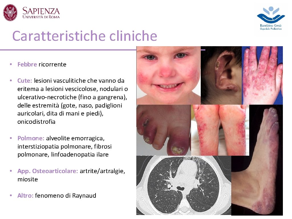 Caratteristiche cliniche • Febbre ricorrente • Cute: lesioni vasculitiche vanno da eritema a lesioni