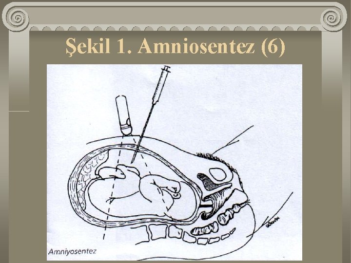 Şekil 1. Amniosentez (6) 