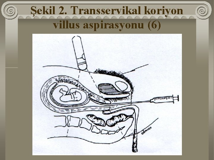 Şekil 2. Transservikal koriyon villus aspirasyonu (6) 