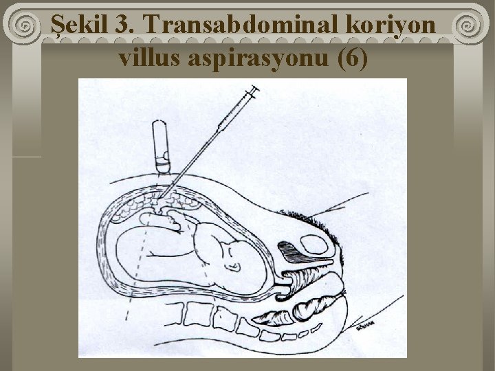 Şekil 3. Transabdominal koriyon villus aspirasyonu (6) 