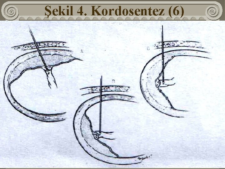 Şekil 4. Kordosentez (6) 