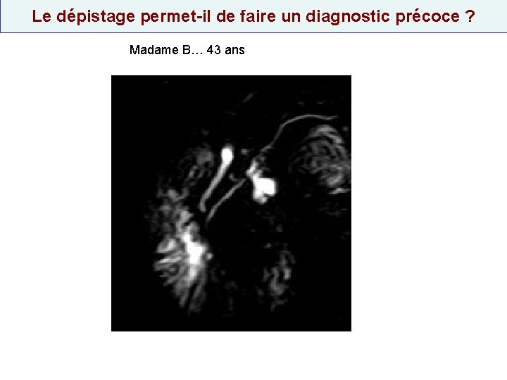 Le dépistage permet-il de faire un diagnostic précoce ? Madame B… 43 ans 