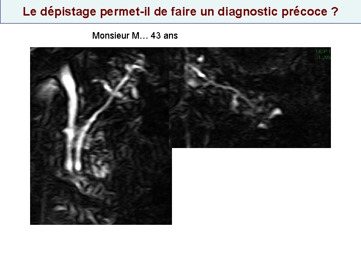 Le dépistage permet-il de faire un diagnostic précoce ? Monsieur M… 43 ans 
