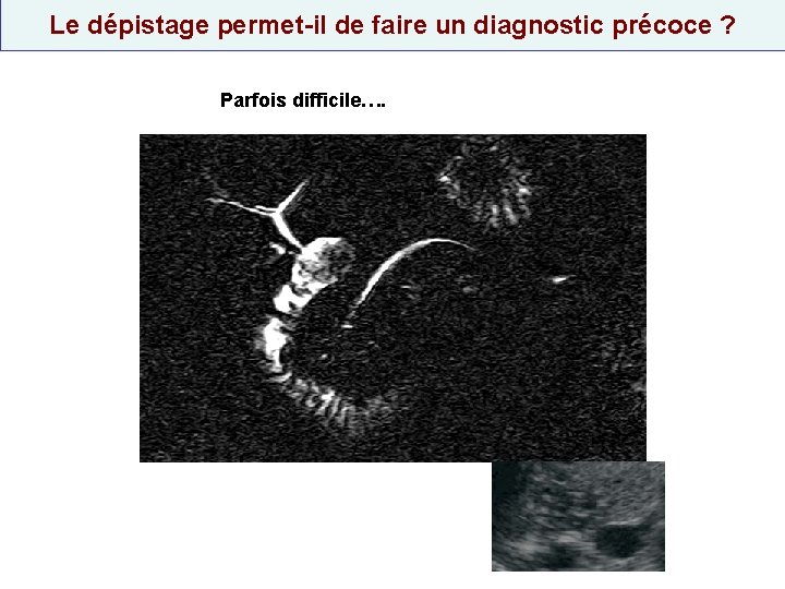 Le dépistage permet-il de faire un diagnostic précoce ? Parfois difficile…. 