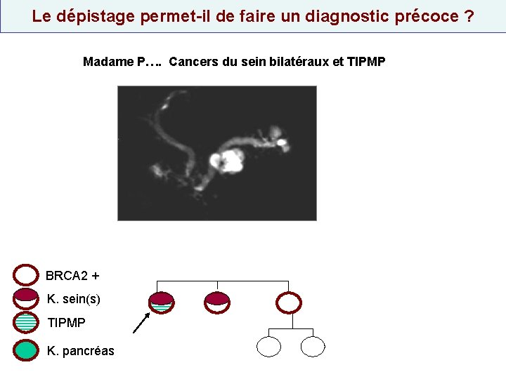 Le dépistage permet-il de faire un diagnostic précoce ? Madame P…. Cancers du sein