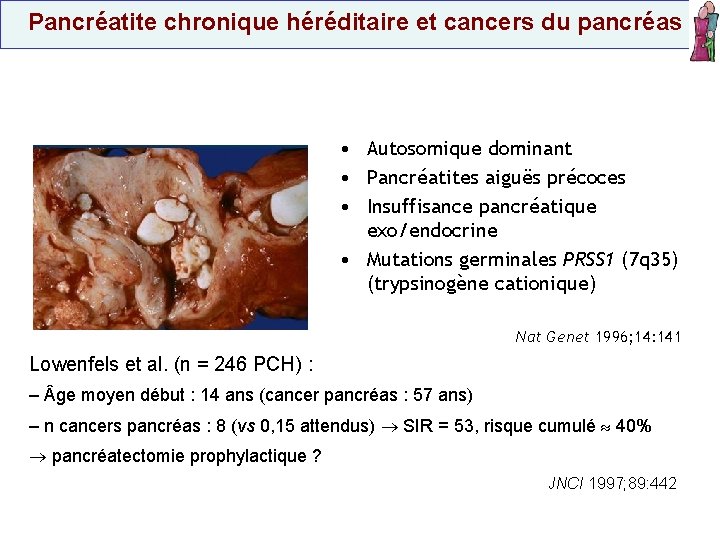  Pancréatite chronique héréditaire et cancers du pancréas • Autosomique dominant • Pancréatites aiguës