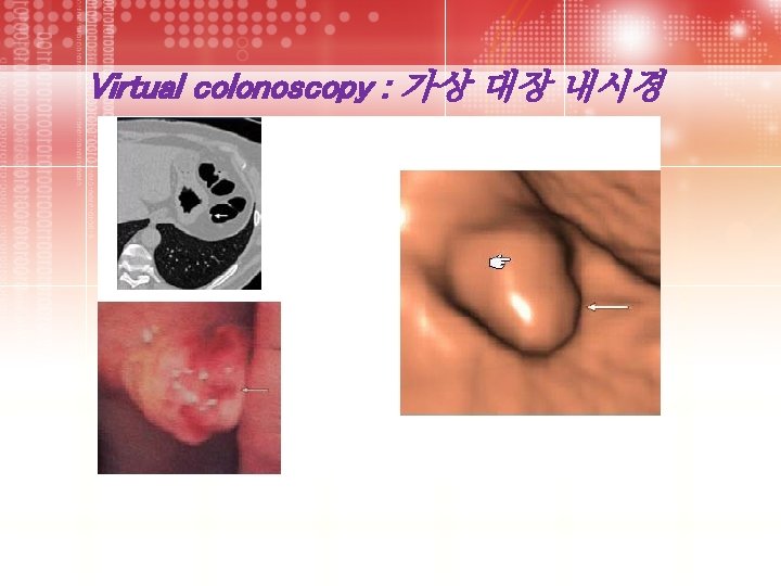 Virtual colonoscopy : 가상 대장 내시경 