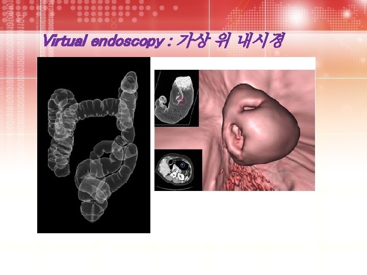 Virtual endoscopy : 가상 위 내시경 