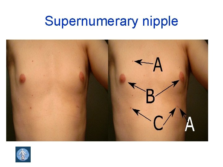 Supernumerary nipple 