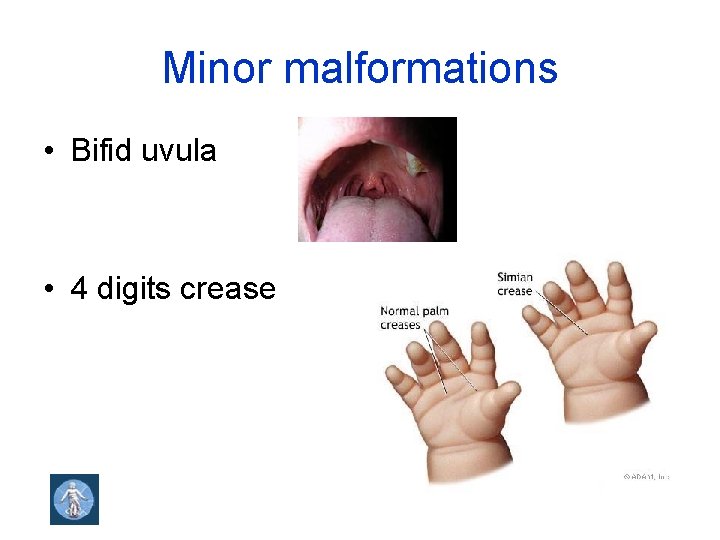 Minor malformations • Bifid uvula • 4 digits crease 