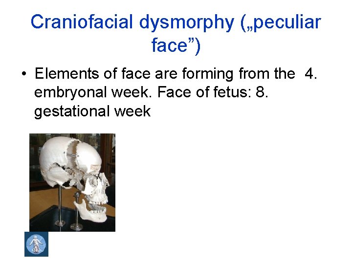 Craniofacial dysmorphy („peculiar face”) • Elements of face are forming from the 4. embryonal