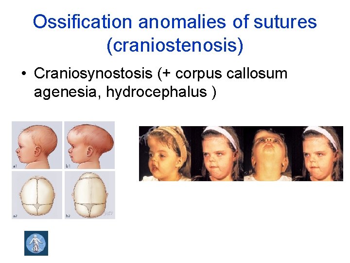 Ossification anomalies of sutures (craniostenosis) • Craniosynostosis (+ corpus callosum agenesia, hydrocephalus ) 