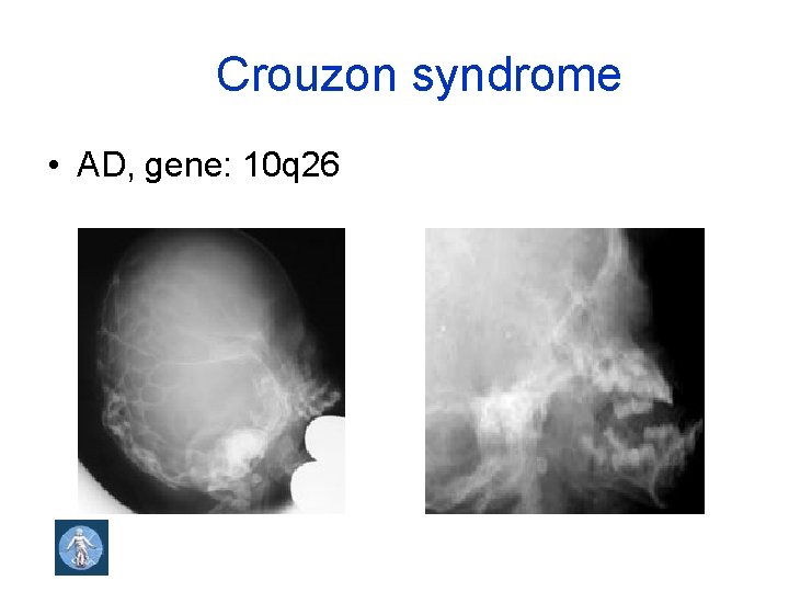 Crouzon syndrome • AD, gene: 10 q 26 