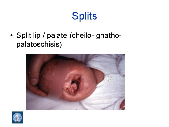 Splits • Split lip / palate (cheilo- gnatho- palatoschisis) 