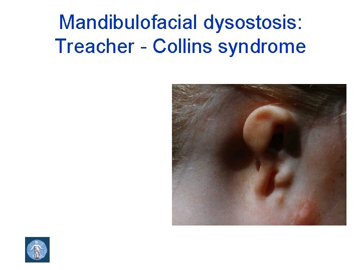 Mandibulofacial dysostosis: Treacher - Collins syndrome 