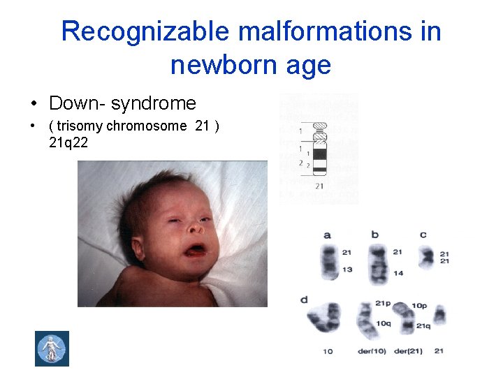 Recognizable malformations in newborn age • Down- syndrome • ( trisomy chromosome 21 )