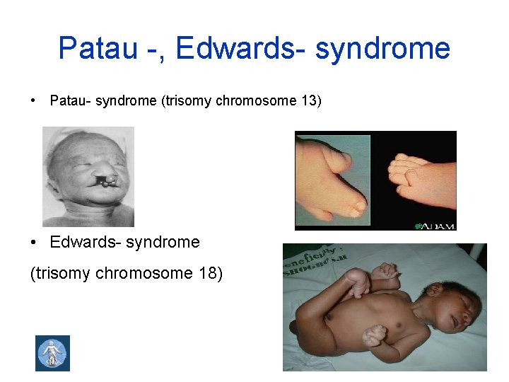 Patau -, Edwards- syndrome • Patau- syndrome (trisomy chromosome 13) • Edwards- syndrome (trisomy