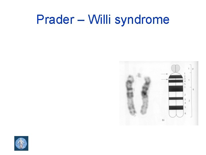 Prader – Willi syndrome 