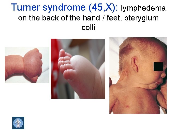 Turner syndrome (45, X): lymphedema on the back of the hand / feet, pterygium