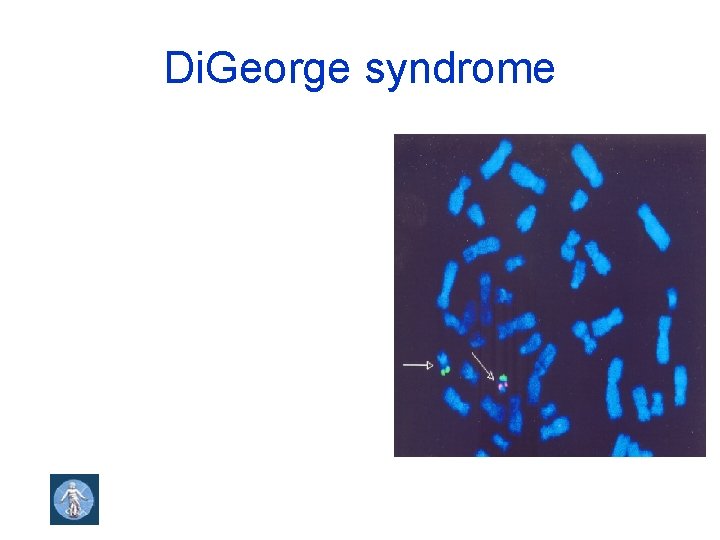 Di. George syndrome 