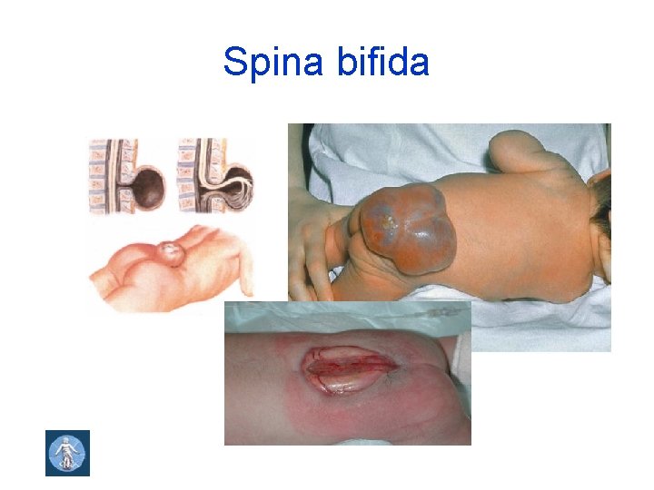 Spina bifida 