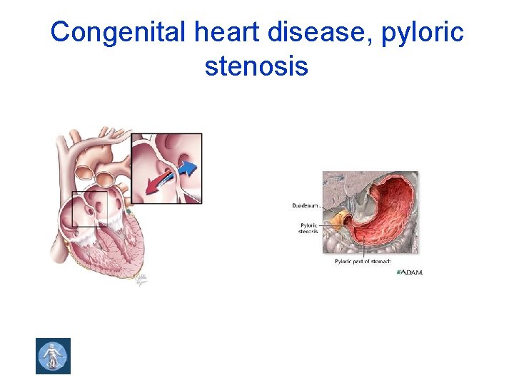 Congenital heart disease, pyloric stenosis 