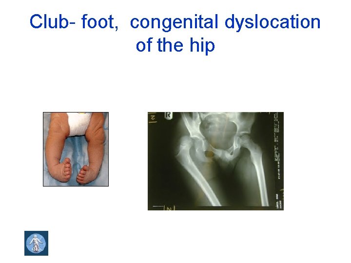 Club- foot, congenital dyslocation of the hip 