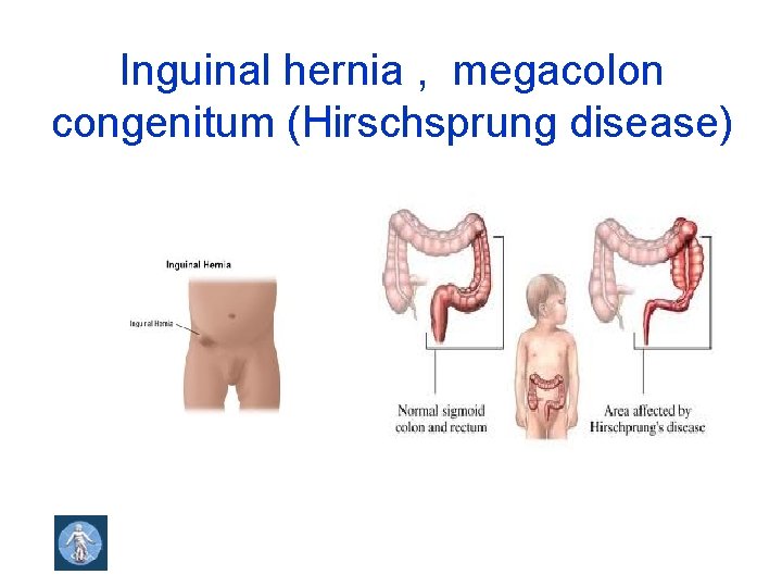 Inguinal hernia , megacolon congenitum (Hirschsprung disease) 