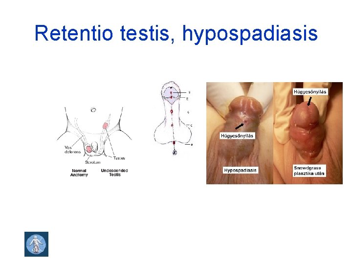 Retentio testis, hypospadiasis 