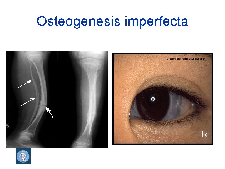 Osteogenesis imperfecta 