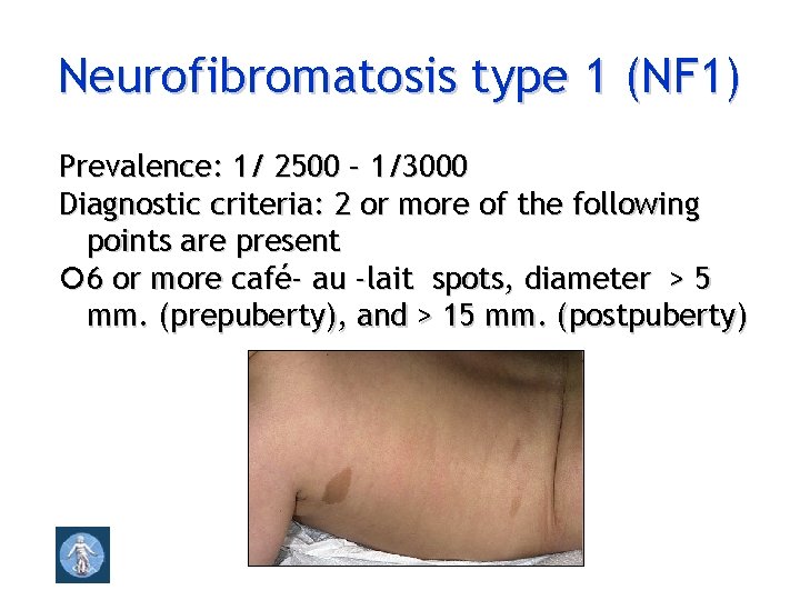 Neurofibromatosis type 1 (NF 1) Prevalence: 1/ 2500 – 1/3000 Diagnostic criteria: 2 or