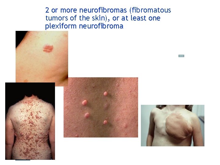 2 or more neurofibromas (fibromatous ( tumors of the skin), or at least one