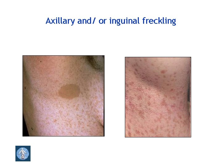 Axillary and/ or inguinal freckling 