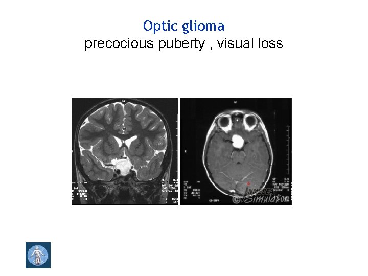 Optic glioma precocious puberty , visual loss 