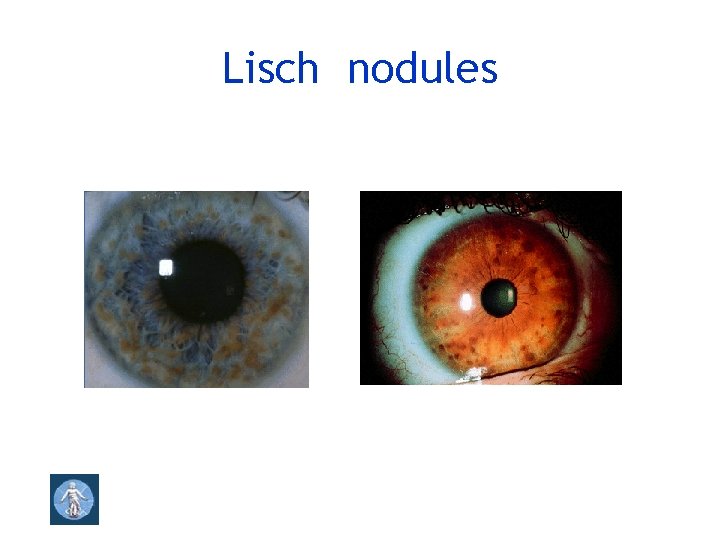 Lisch nodules 