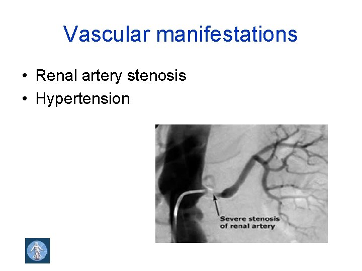 Vascular manifestations • Renal artery stenosis • Hypertension 