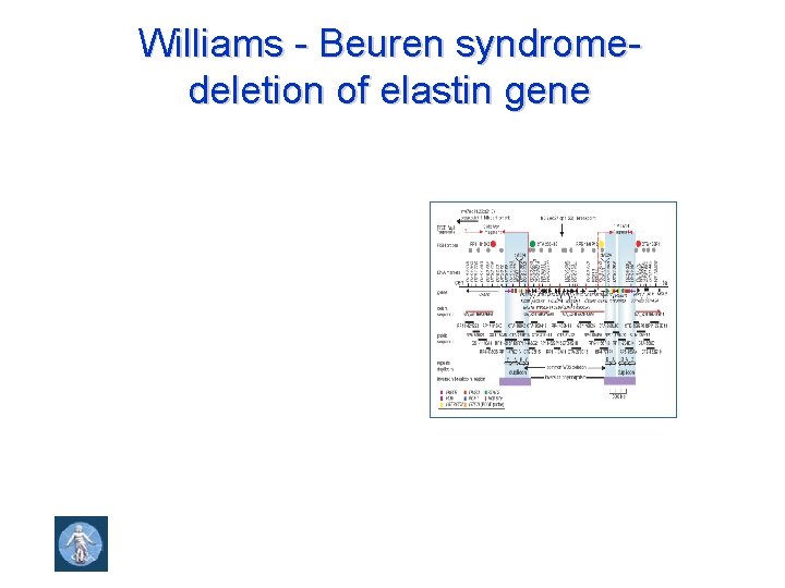 Williams - Beuren syndromedeletion of elastin gene 