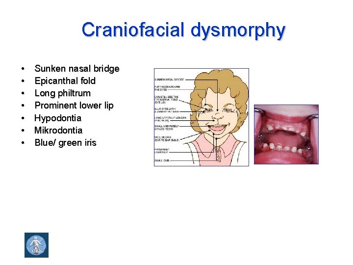 Craniofacial dysmorphy • • Sunken nasal bridge Epicanthal fold Long philtrum Prominent lower lip