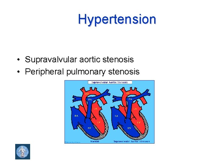 Hypertension • Supravalvular aortic stenosis • Peripheral pulmonary stenosis 