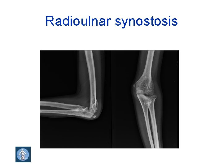 Radioulnar synostosis 